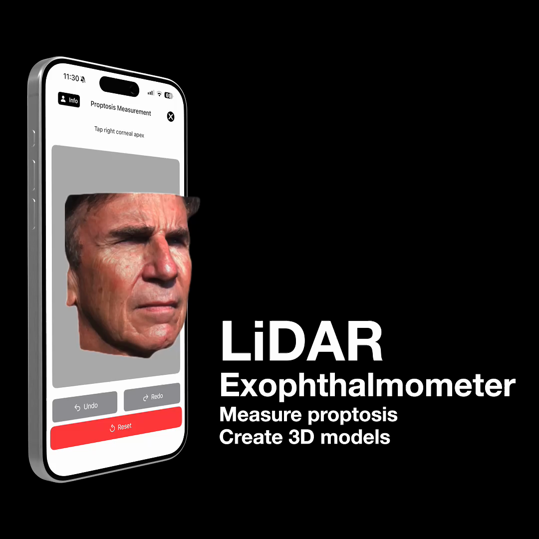 LiDAR Exophthalmometer 3D Proptosis Measurement