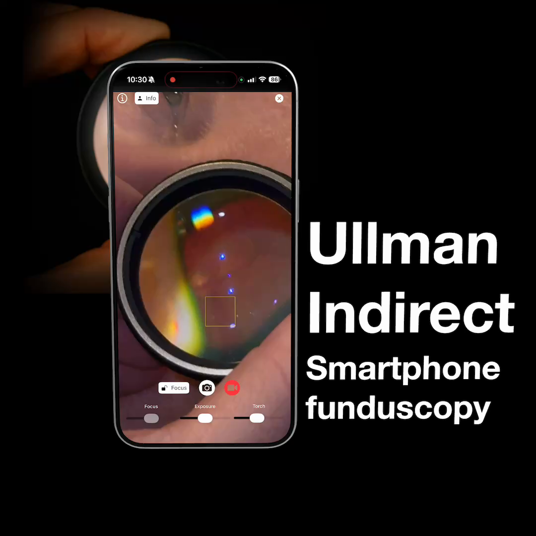 Ullman Indirect Ophthalmoscope Fundus Examination